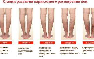 Как лечить варикоз