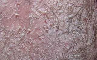 Почему шелушится кожа на яичках