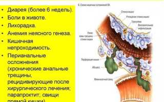 Как лечить болезнь Крона