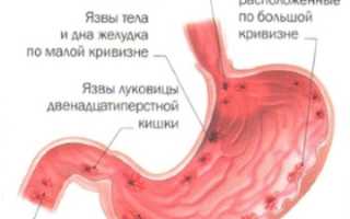 Симптомы язвы кишечника