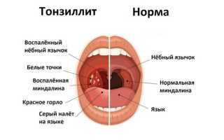 Симптомы хронического тонзиллита