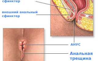 Определение анальной трещины