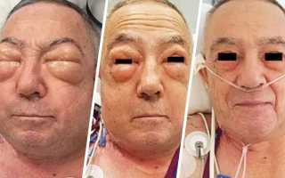 Воздух в легких после операции на легких