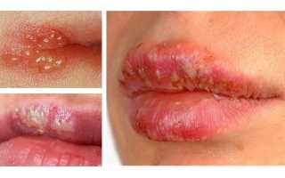 Герпес на губах – некрасивая болезнь