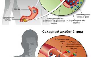Как вылечить диабет 1 типа