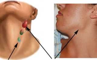 Как лечить подчелюстные лимфоузлы