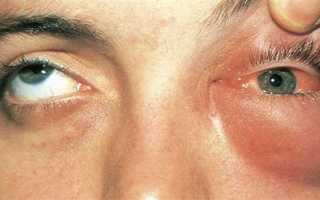 Как лечить отек на веке