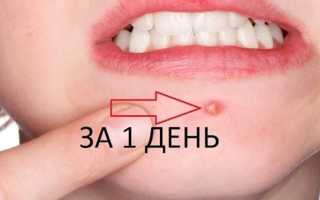 6 волшебных способов избавиться от прыщей за ночь