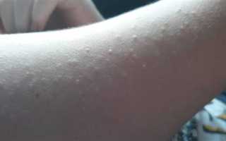 Как лечить красную сыпь – крапивница, потница или аллергия