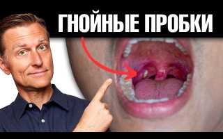 Как избавиться от гнойников в горле