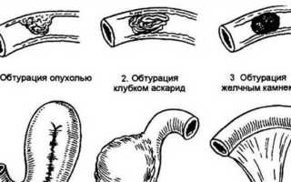 Как лечить непроходимость кишечника