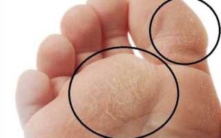 Как избавиться от натоптышей на пятках
