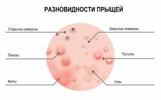 Главная причина белых прыщиков