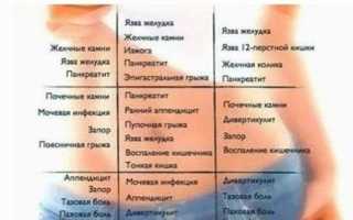 Для каких заболеваний характерны левосторонние боли внизу живота