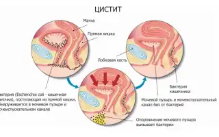 Как лечить цистит