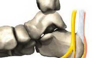 Как лечить шпору на пятке