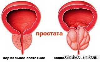 Как лечить простатит народными средствами