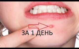 Как избавиться от прыщей за 1 день