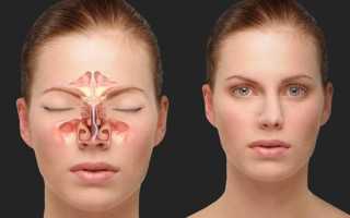 Удаление перегородки в носу