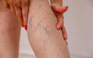 Как избавиться от варикоза