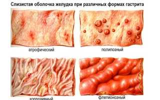Как лечить различные виды гастрита