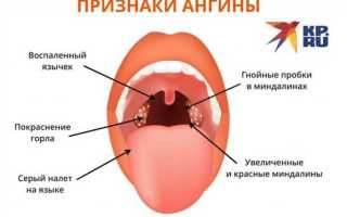Как лечить ангину у ребенка