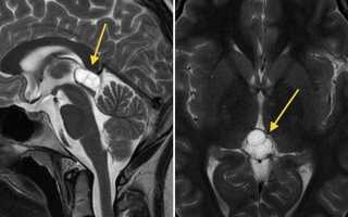 Киста шишковидной железы головного мозга