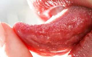 Воспаление сосочков языка – причины и симптомы