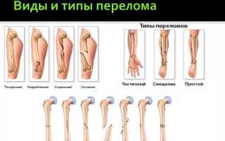 Все о переломе ноги