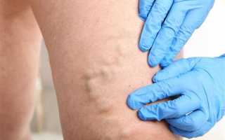 Как избавиться от варикоза: эффективные методы и рекомендации