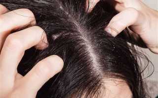 Что такое перхоть и как от нее избавиться