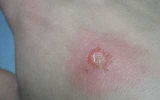 Лечение ожогов от травы