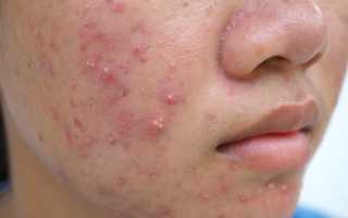 Как лечить красные прыщи
