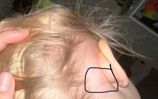 Чем лечить лимфоузлы за ухом