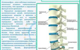 Виды остеохондроза и методы лечения