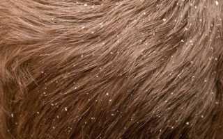 Как лечить сухую кожу головы