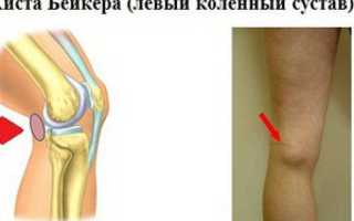 Как лечить кисту сустава