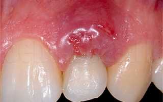 Профилактика периостита