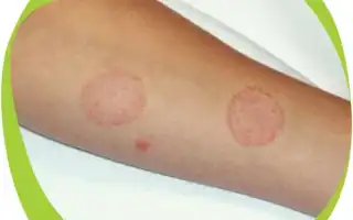 Как лечить лишай у ребёнка