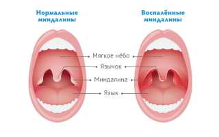 Особенности диагностики и лечения ангины у новорожденных: важные аспекты, на которые следует обратить внимание