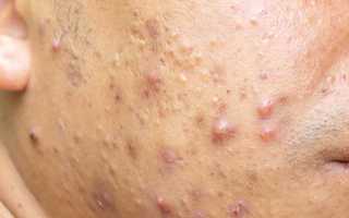 Как вылечить демодекс