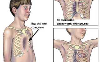 Как лечить деформацию грудной клетки