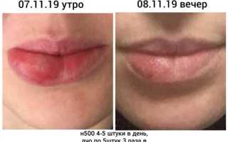 Методы для быстрого избавления от герпеса на губах