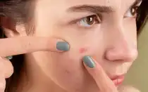 Избавляемся от прыщей и угрей в домашних условиях