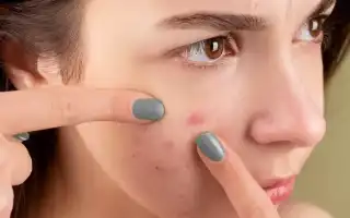 Избавляемся от прыщей и угрей в домашних условиях
