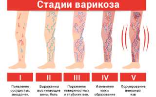 Как вылечить варикоз на ногах