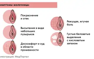 Симптомы молочницы у девушек
