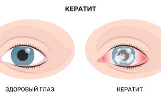 Основные симптомы глазных болезней