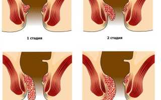 Симптомы геморроя у женщин