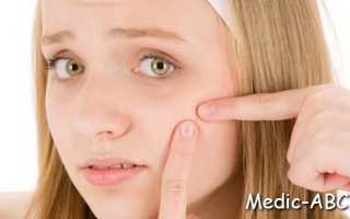 Почему появляются мелкие прыщи на лице